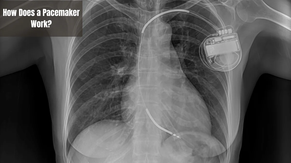 Pacemaker